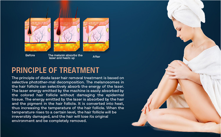 808nm Diode Laser Hair Removal Machine 1800W 12 Laser Bar diode ice laser