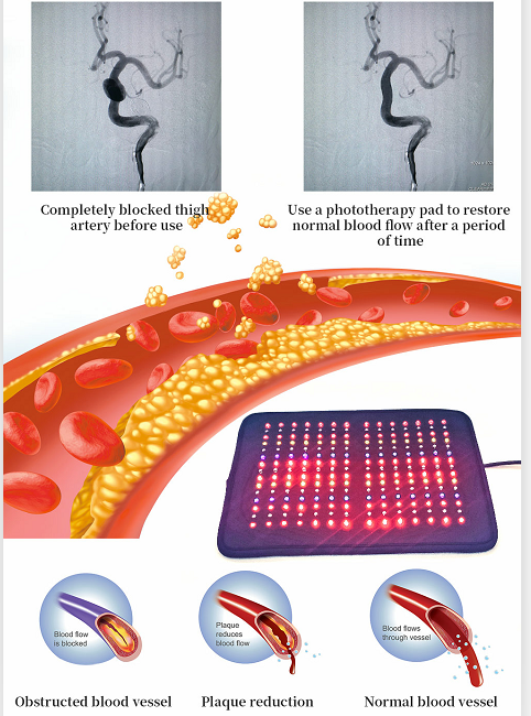 FDA 12V Multi Function Infrared Light Therapy Pads Medical Phototherapy System