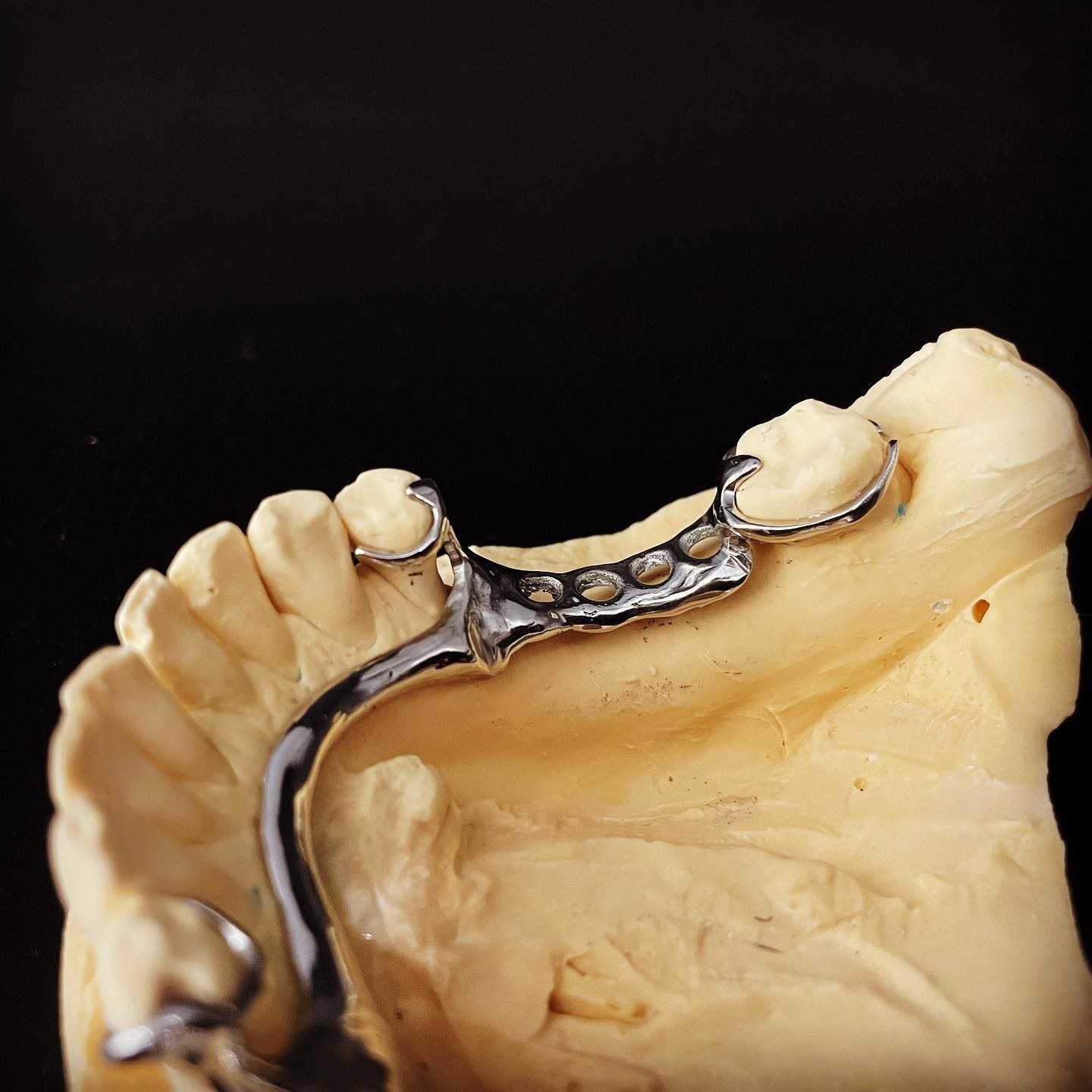 Fast and Cast Framework Co-Cr Metal Partial Denture Framework for Dental Professionals
