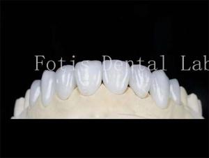 China Natural Color Dental Laminate Veneers Fake Teeth Veneers With Bonding Cement wholesale
