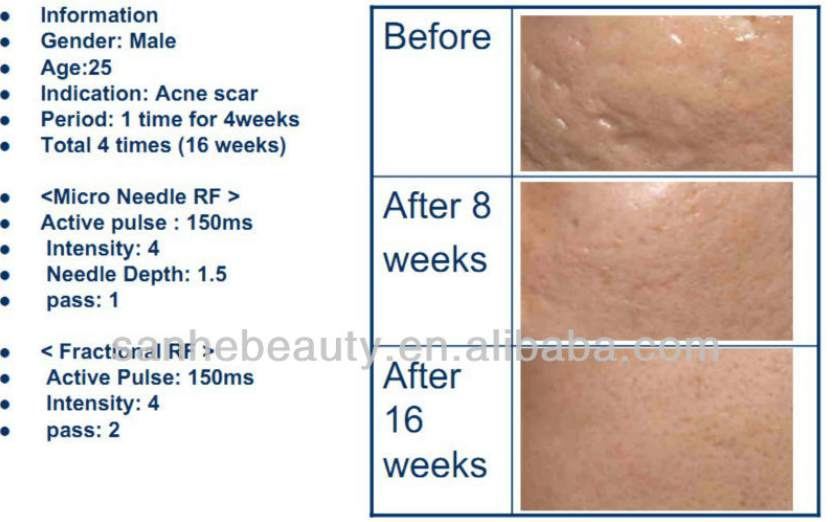 NEW Micro needle rf machine for skin tightening face left / fractional rf microneedle rf machine