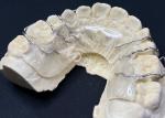 Hawley retainer Orthodontic Appliances for Comfortable Teeth Alignment