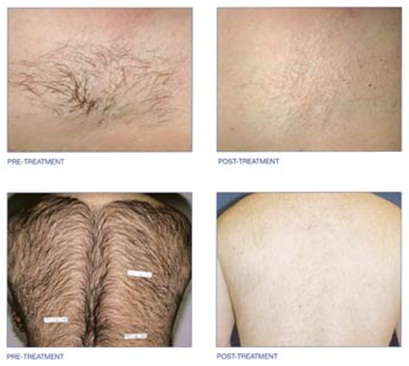 strong power painless portable 808nm diode laser hair removal device for salon use