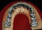 Highly Durable Restoration Porcelain Fused To Metal Crown For Natural Looking