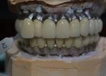 Prioritizing Patient Satisfaction Our Commitment To Quality Dental Implant