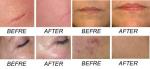 Beijing SANHE Q-switch nd yag laser for different colors tattoo removal and skin