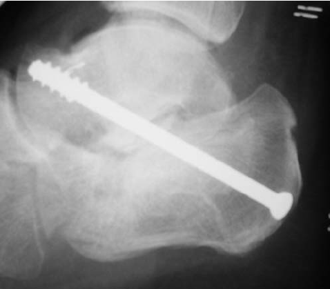 Cortex Bone Locking Medical Bone Screw Class II Precision Engineered