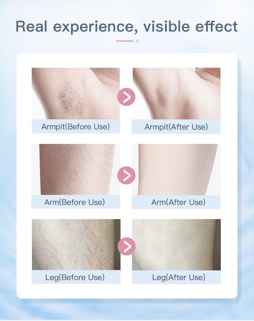 36Watt Home Laser Hair Removal Device