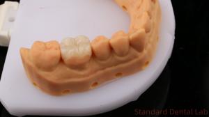 China Translucency Zirconia Dental Inlay Onlay Crown For Restore Natural Cavity Shape / Standard Dental Lab wholesale