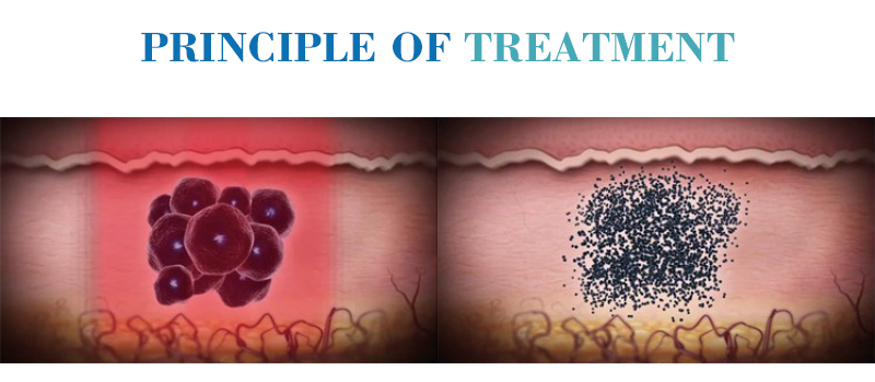 picosecond laser treatment.jpg