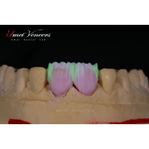 Natural White Cast Porcelain Veneers