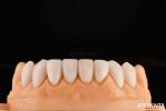Ultra Thin IPS Emax Press Veneers Cosmetic Teeth Veneers For Anterior Posterior