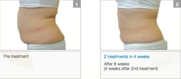 LED Light Professional 4 handpiece cryolipolysis fat freezing / cryolipolysis