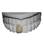 Co Cr Porcelain Dental Crown