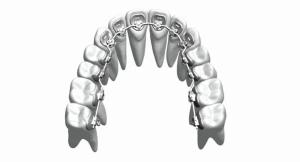 China Custom Fixed Orthodontic Appliances Braces Straighten Teeth Stainless Steel Bioceramic wholesale