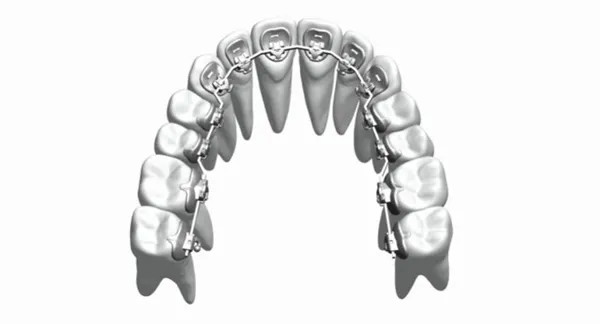Custom Fixed Orthodontic Appliances Braces Straighten Teeth Stainless Steel