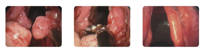 Cryogenic Radio Frequency Plasma Surgery System Minimal Invasive