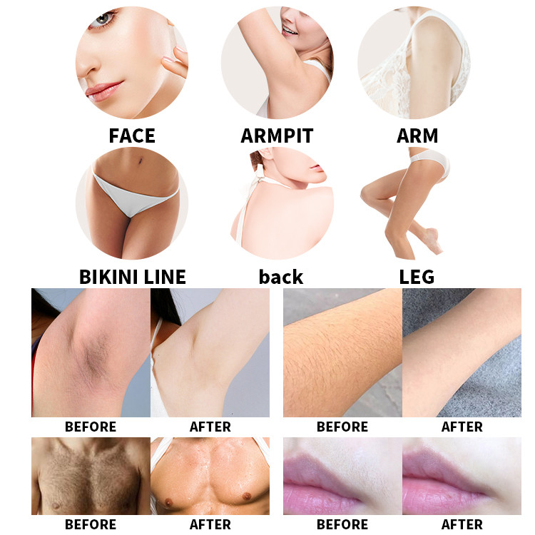 Fast Diode Laser Hair Removal Machine Triple Wave 810nm Skin Rejuvenation 2000w