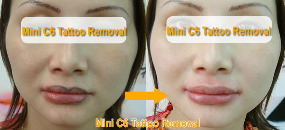Beauty Salon Pico Laser Machine YAG Laser Tattoo Removal Machine 1064 Nm / 532nm Wavelength