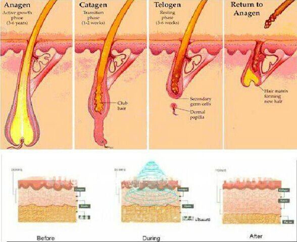 high quality hair removal shr laser