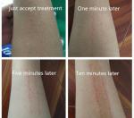 Beijing SANHE Q-switch nd yag laser for different colors tattoo removal and skin