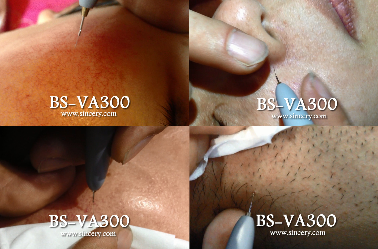 30MHz Vascular Removal Machine , Skin Tag Removal Machine With 1-100 Levels Energy