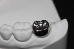 Natural Colour Stability FDA Dental Crown Bridge Corrosion Resistant