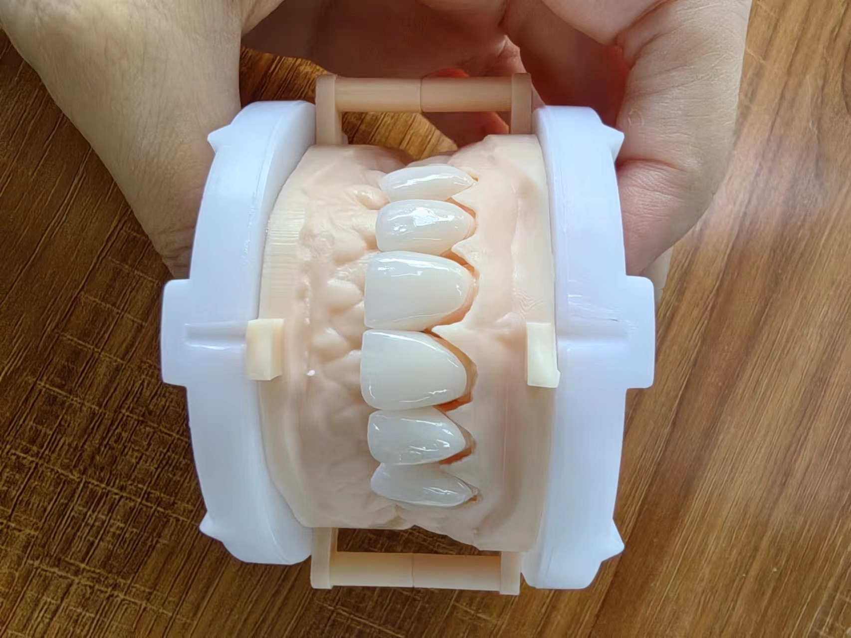 Highly Translucent Layered Zirconia Crowns Natural With Implant Crown