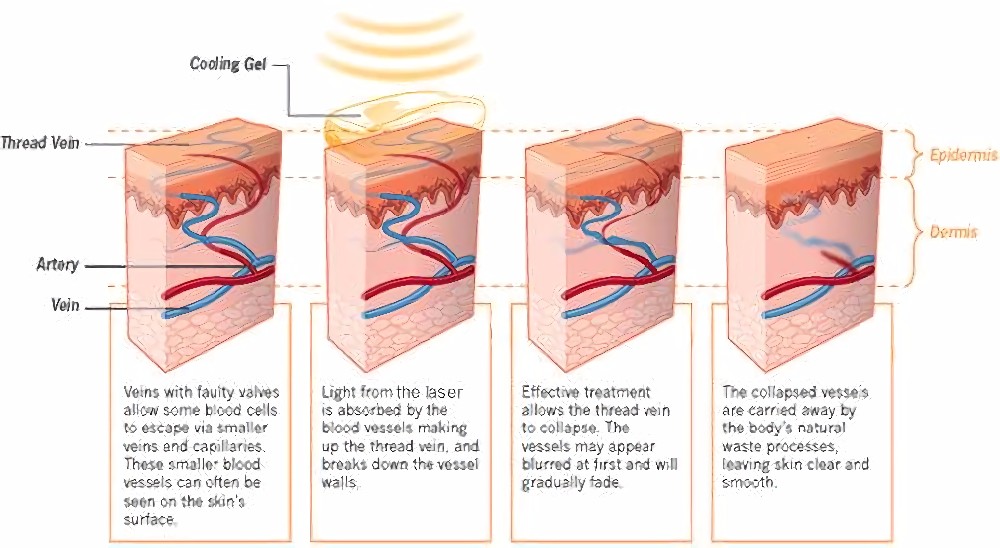 Skin Rejuvenation Spider Vein Treatment Machine , Adjustable Laser Vein Removal Machine