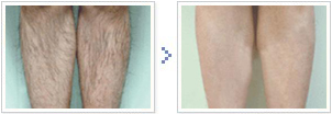 most effective 808 Nm Diode Laser Hair Removal Machine for beauty spa use