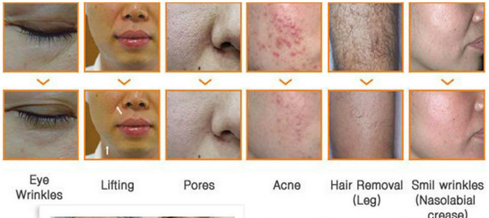 E-light IPL RF SHR Hair Removal / Spider Veins Treatment For Beauty Salon