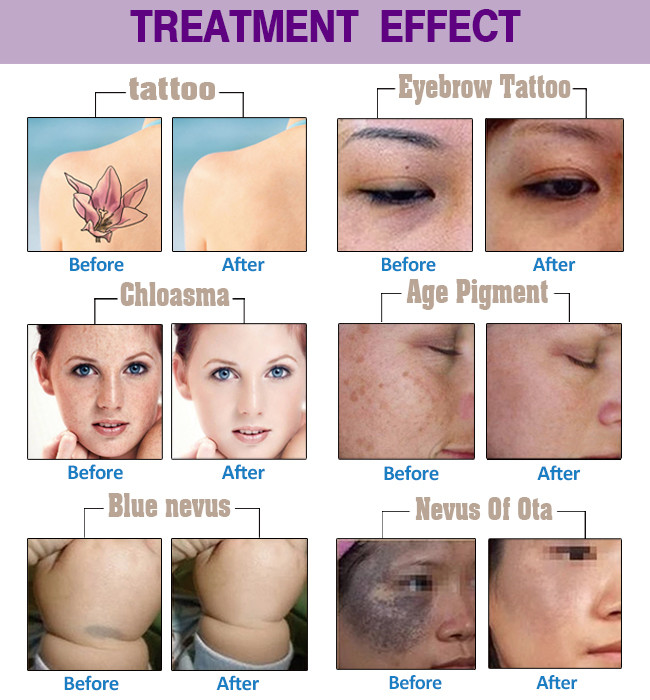 Q Switched Nd Yag Laser / Tattoo Removal / Portable Q Switch Nd Yag Laser