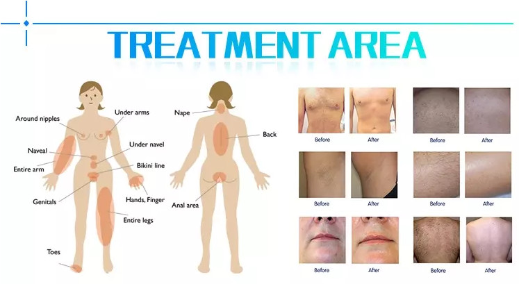 painless hair removal 808nm medical diode laser hair removal machine for sale