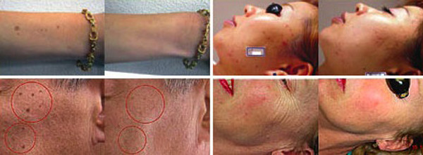 Ipl photofacial machine for home use laser machine price for sale