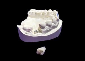 China Dental Implant with Ceramic Crown and titanium Abutment for molar wholesale