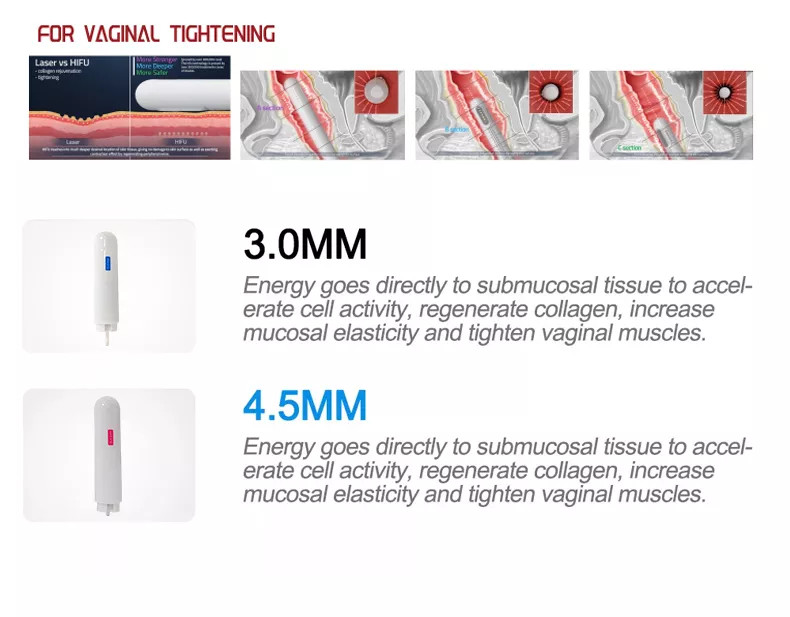 3.0mm HiFu Beauty Machine Single Handle Vaginal Canal Rejuvenation Vaginal Tightening