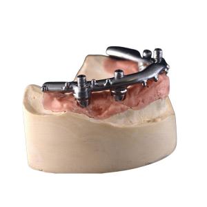 China High-Density PFM Dental Implants Dentures Strong Hardness Long Lasting​ wholesale