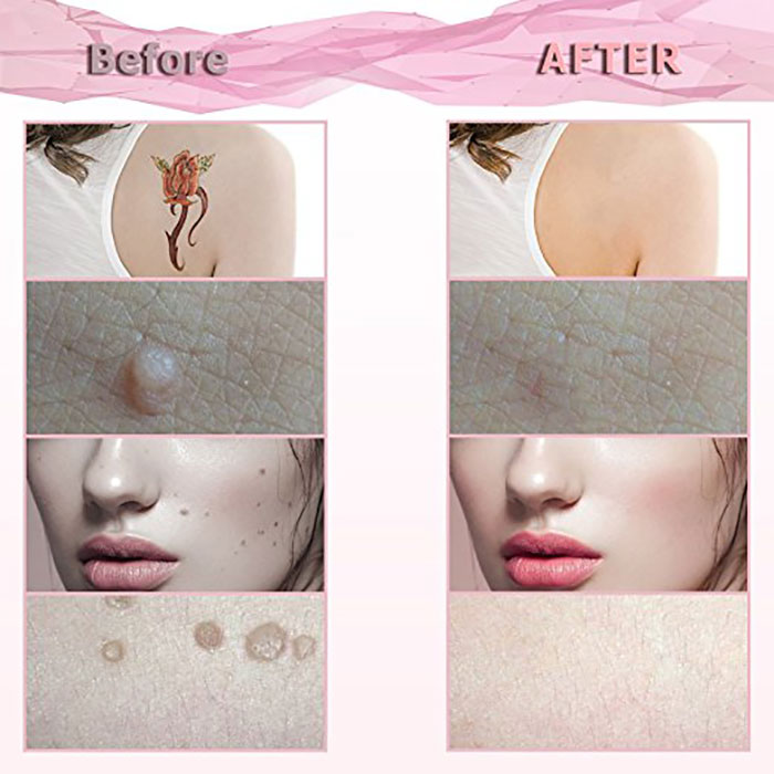 Multifunctional Mole Removal Pen Laser Dark Spot Removal Pen Skin Rejuvenation
