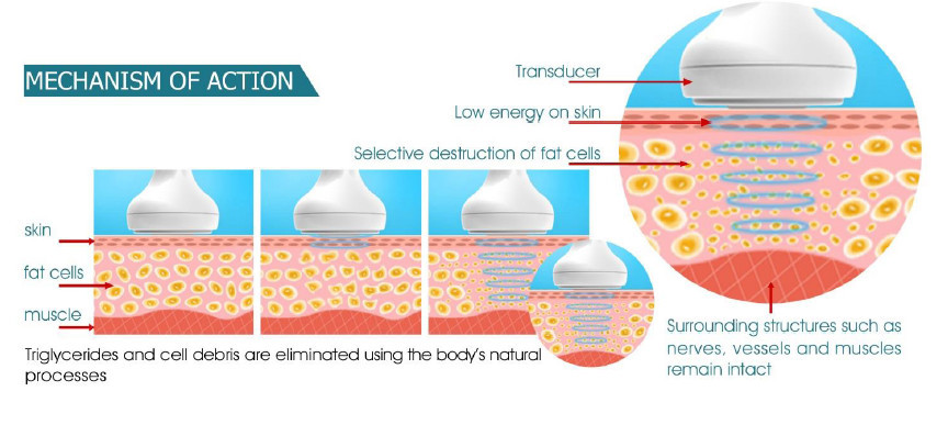 2016 best Focused ultrasound anti cellulite HIFU/ hifu/cavitation hifu