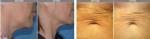 korea best rf stomach laser skin tightening stomach wave ferquency device