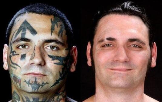 Portable Q - Switch ND Yag Laser q switch tattoo removal machine for all color Skin Type