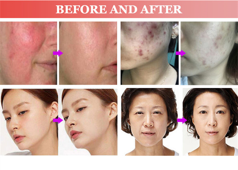 Mini Cold CE Plasma Ozone Pen Dark Circles Removal Pore Clean Skin Lifting