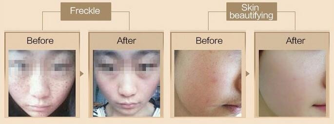 Picosecond q switched nd yag laser picosure q-switched tattoo removal laser machine