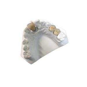 China Yellow Gold Porcelain Dental Crown OEM High Strength New Condition wholesale