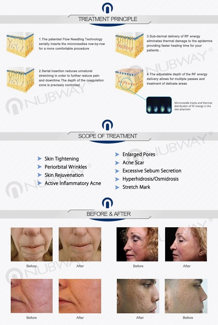 Portable Fractional RF microneedle skin tightening equipment acne scar removal rf micro needle machine