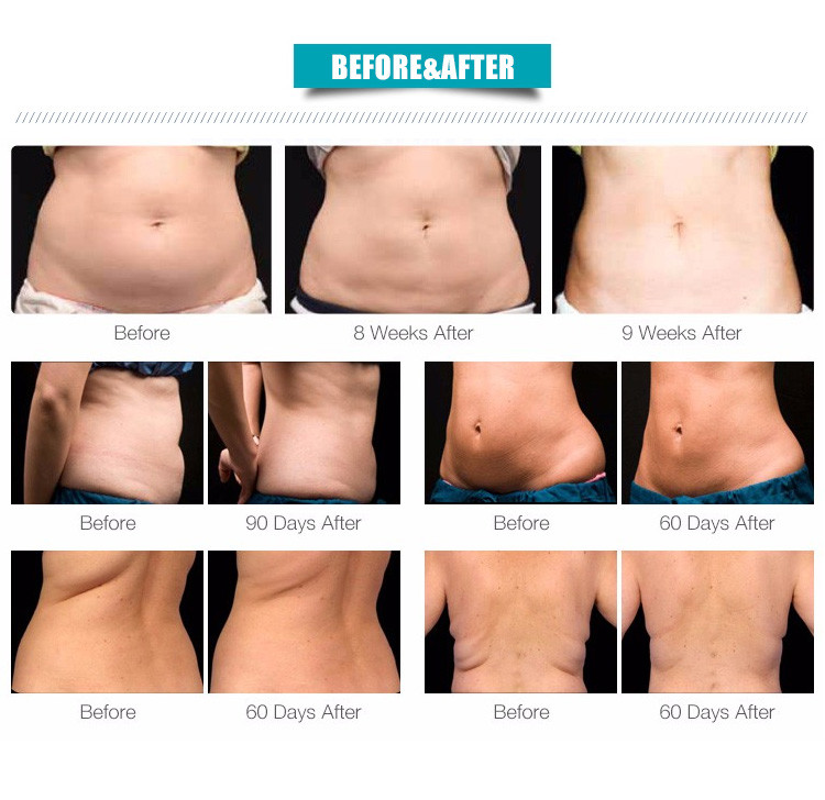 5 In 1 Vacuum Ultrasonic Cavitation Radio Frequency Machine Face Lift Lipo Laser Device