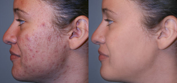 Fractional radiofrequency micro needling skin maintenance microneedle nurse system