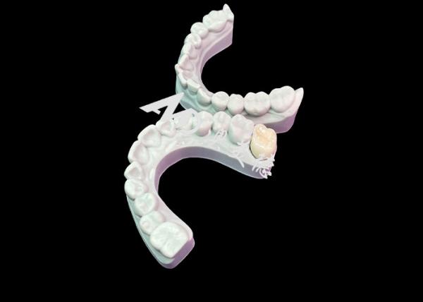 Precise Fit Zirconia Dental Crown Aesthetic Natural Colour Excellent Biocompatib