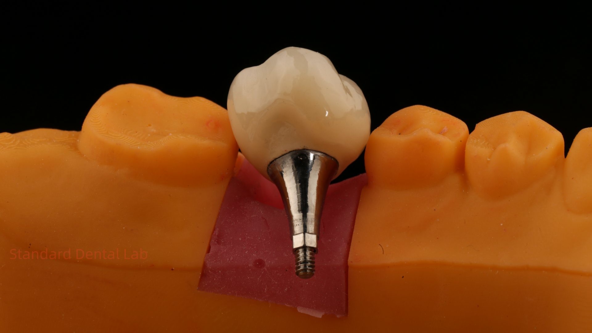 Screw Retained PFZ Porcelain Layered Zirconia Dental Implant Crown from Dental Lab ISO FDA CE Certified with 5-Year Guarantee
