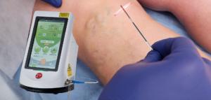 China Berylas Surgical Laser Equipment Pulse Mode No Stitches wholesale